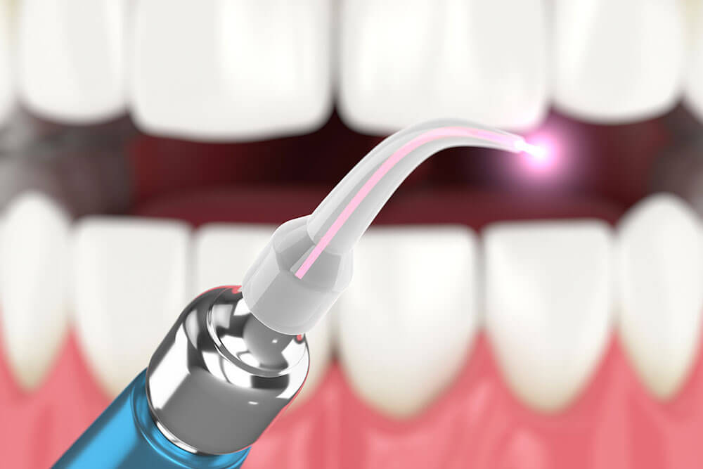 عوارض لیزر در دندانپزشکی