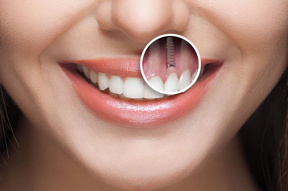 ایمپلنت دندانی؛ همه چیز درباره روش تخصصی کاشت دائمی دندان