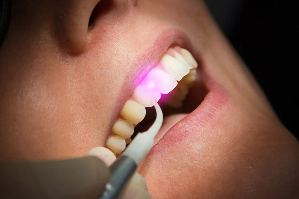 مزایای استفاده از لیزر در دندانپزشکی