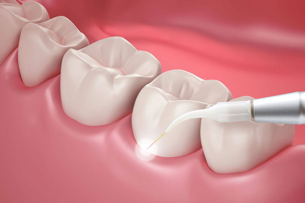 کاربرد لیزر کم توان در دندانپزشکی