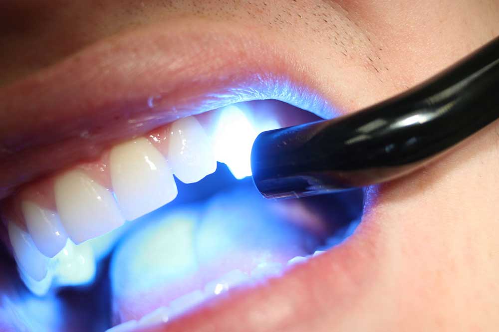هر آنچه باید درباره لایت کیور دندانپزشکی و اشعه آبی آن بدانید!
